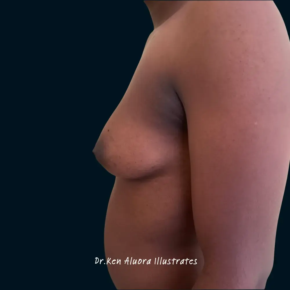 Gynaecomastia | Male Chest Contouring before