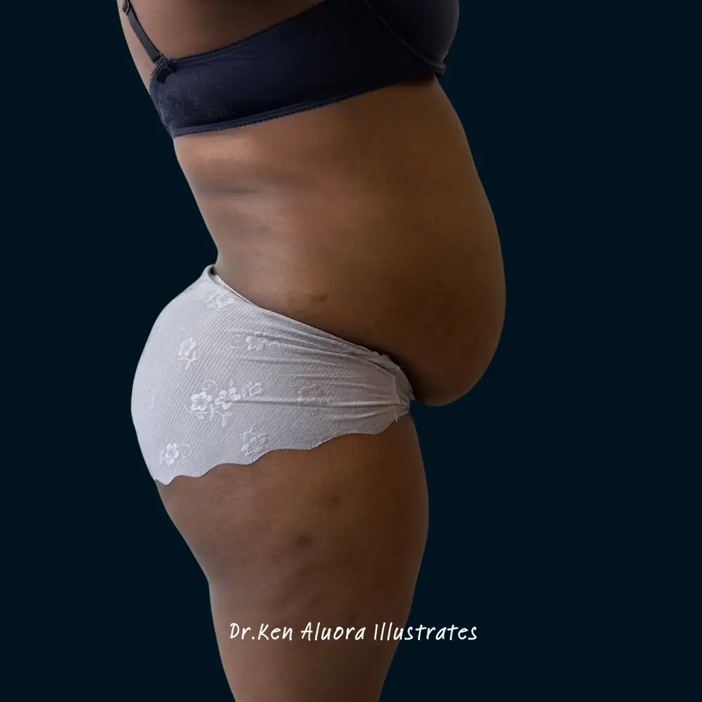 Tummy Tuck | Lateral Abdomen Contouring before