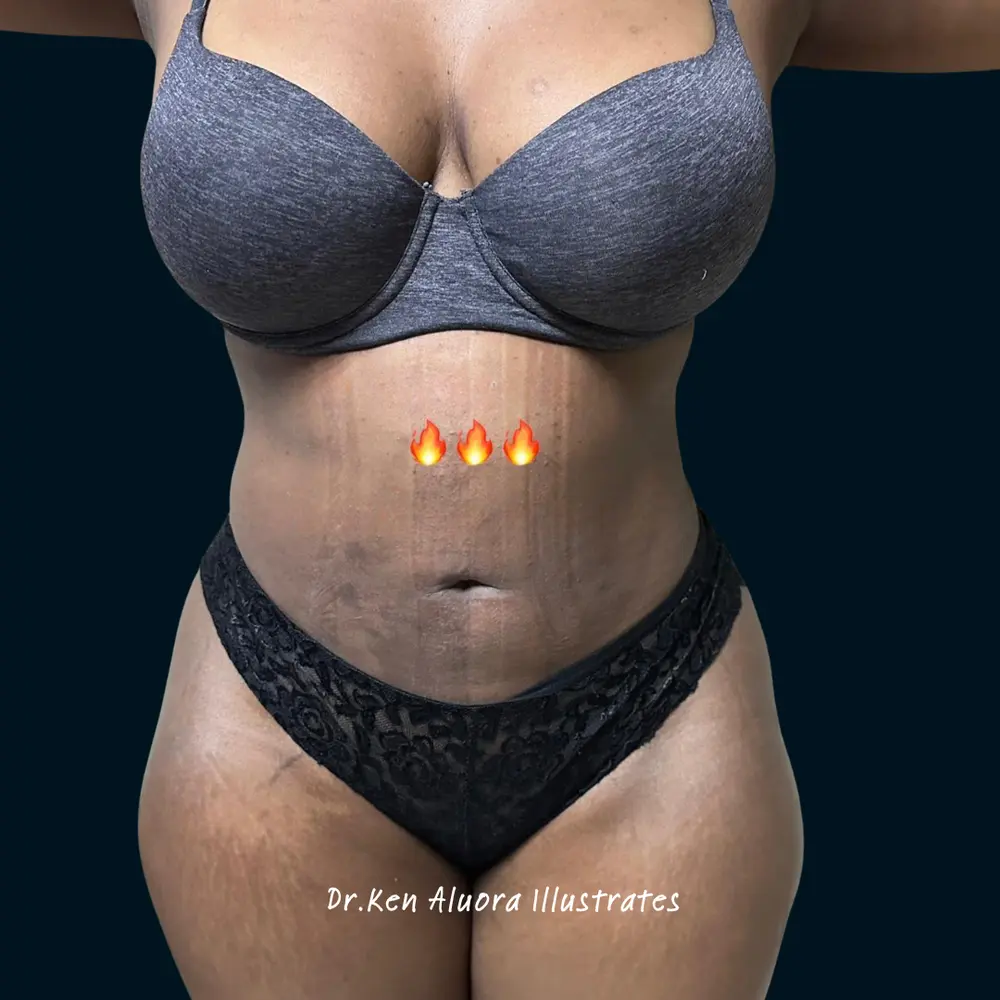 Liposuction | Midsection Sculpting after