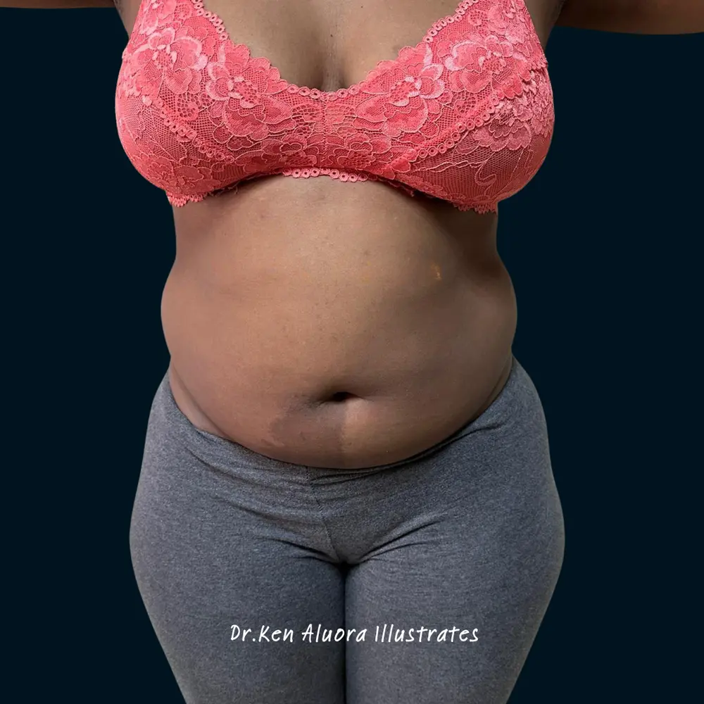 Liposuction | Midsection Sculpting before