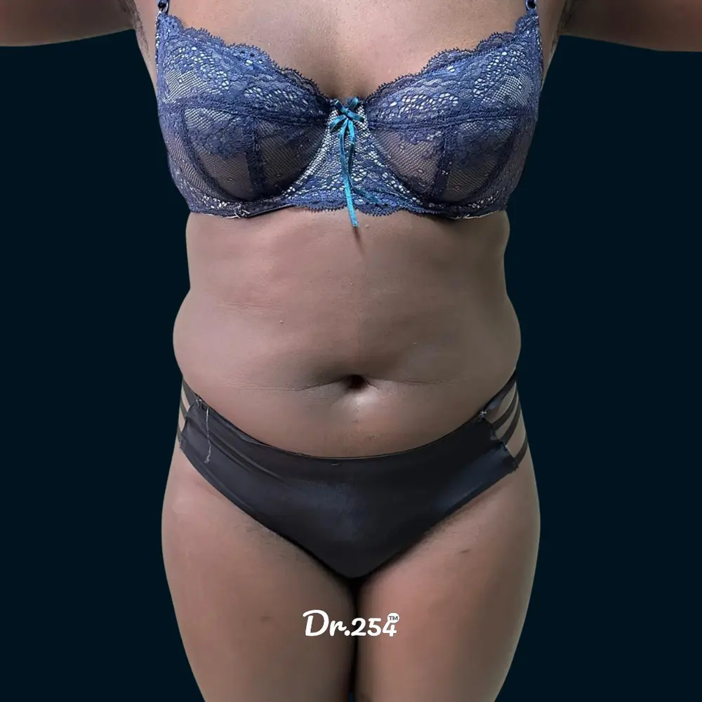 Liposuction | Abdomen & Flank Definition before