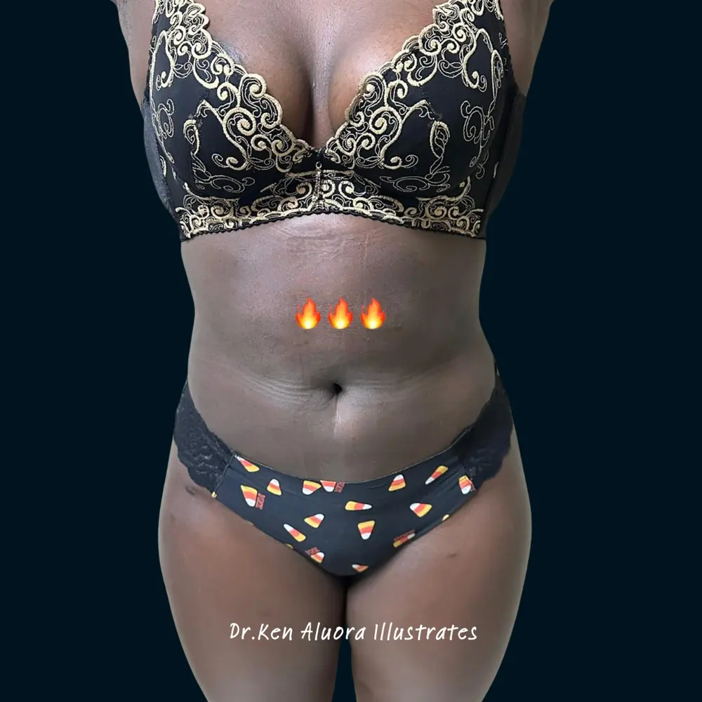 Liposuction | Abdomen & Flank Definition after