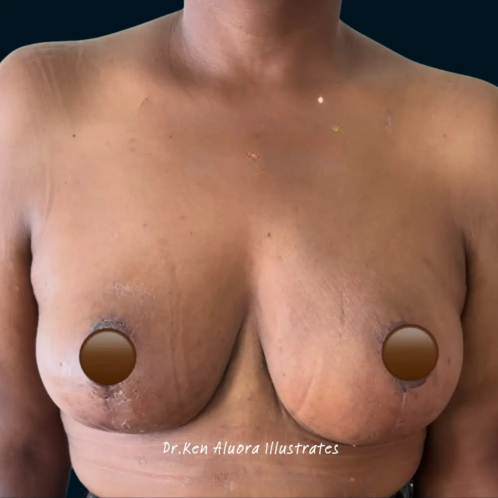 Breast Reduction | Multi-Angle Contouring after