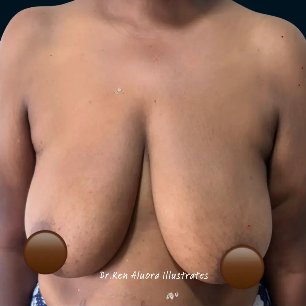 Breast Reduction | Multi-Angle Contouring before