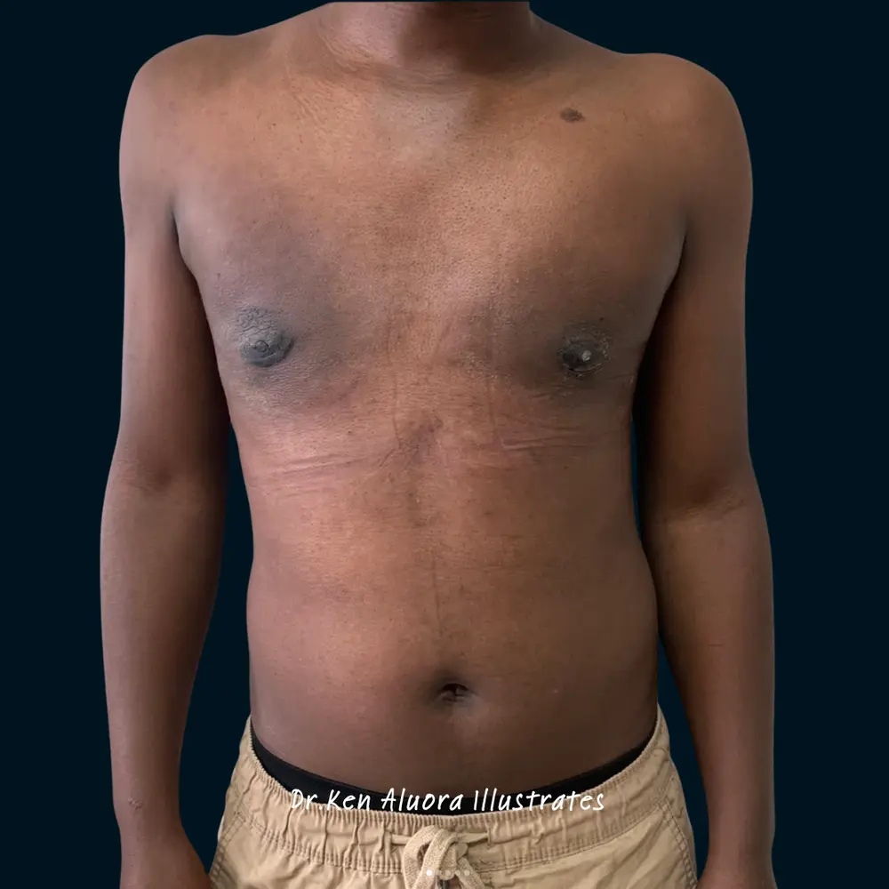 Gynaecomastia | Male Chest Contouring after