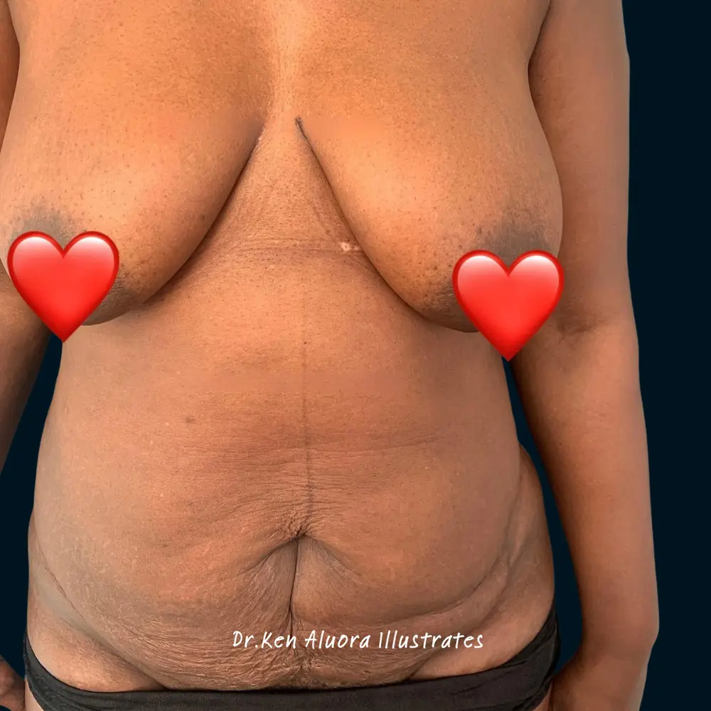 Mommy Makeover | Breast & Abdomen Refresh before