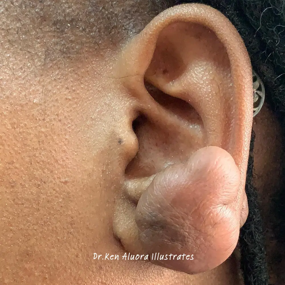 Keloid | Earlobe Excision before