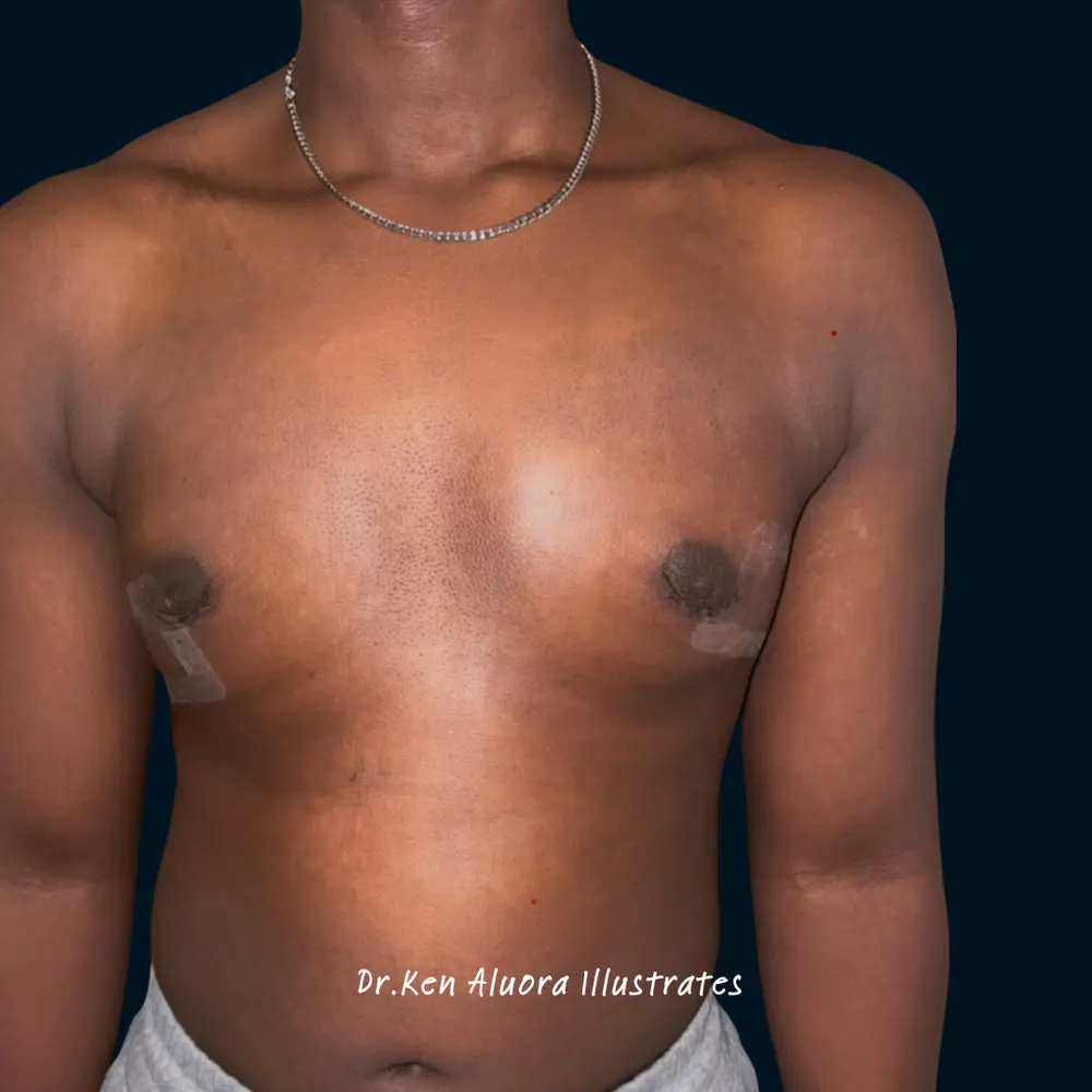 Gynaecomastia | Areolar Contouring after