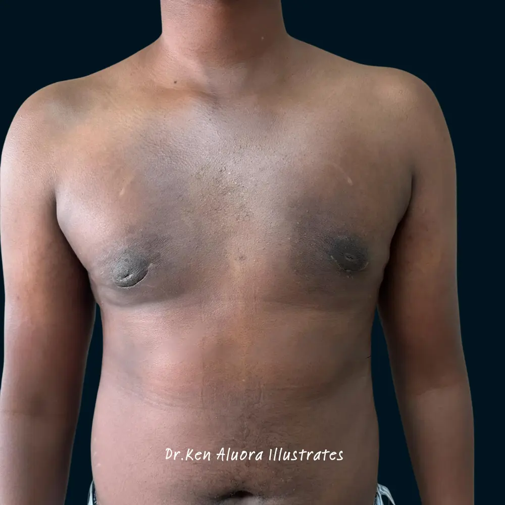 Gynaecomastia | Grade III Chest Reduction after