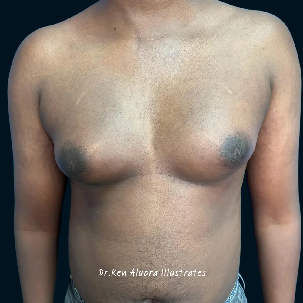 Gynaecomastia | Grade III Chest Reduction before