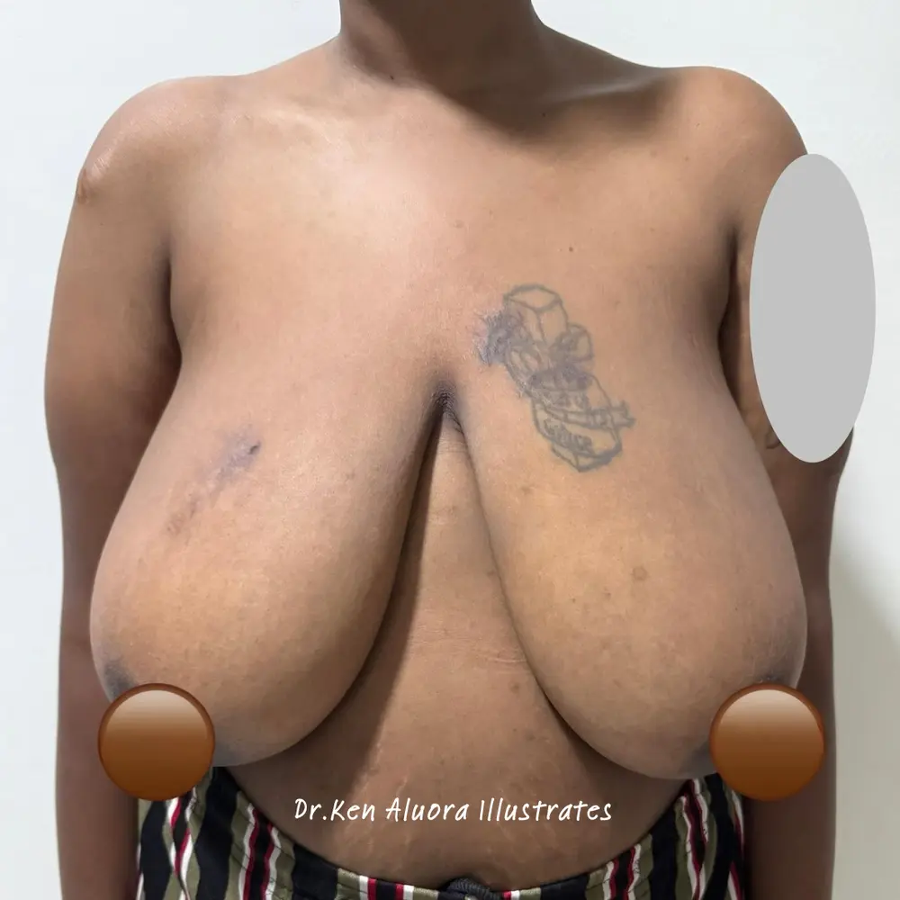 Gigantomastia | Tattoo-Marked Reduction before