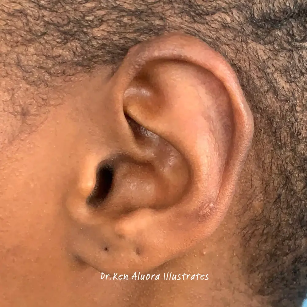 Keloid | Double Earlobe Masses after