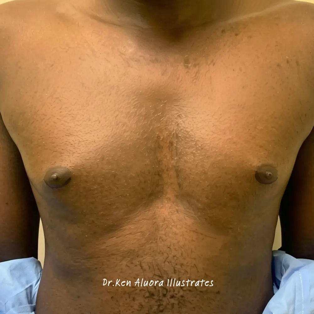 Gynaecomastia | Areolar Contouring before