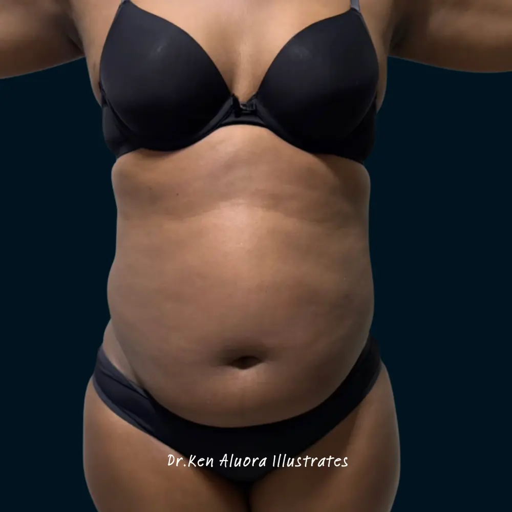 Liposuction | Hourglass Waist Contouring before