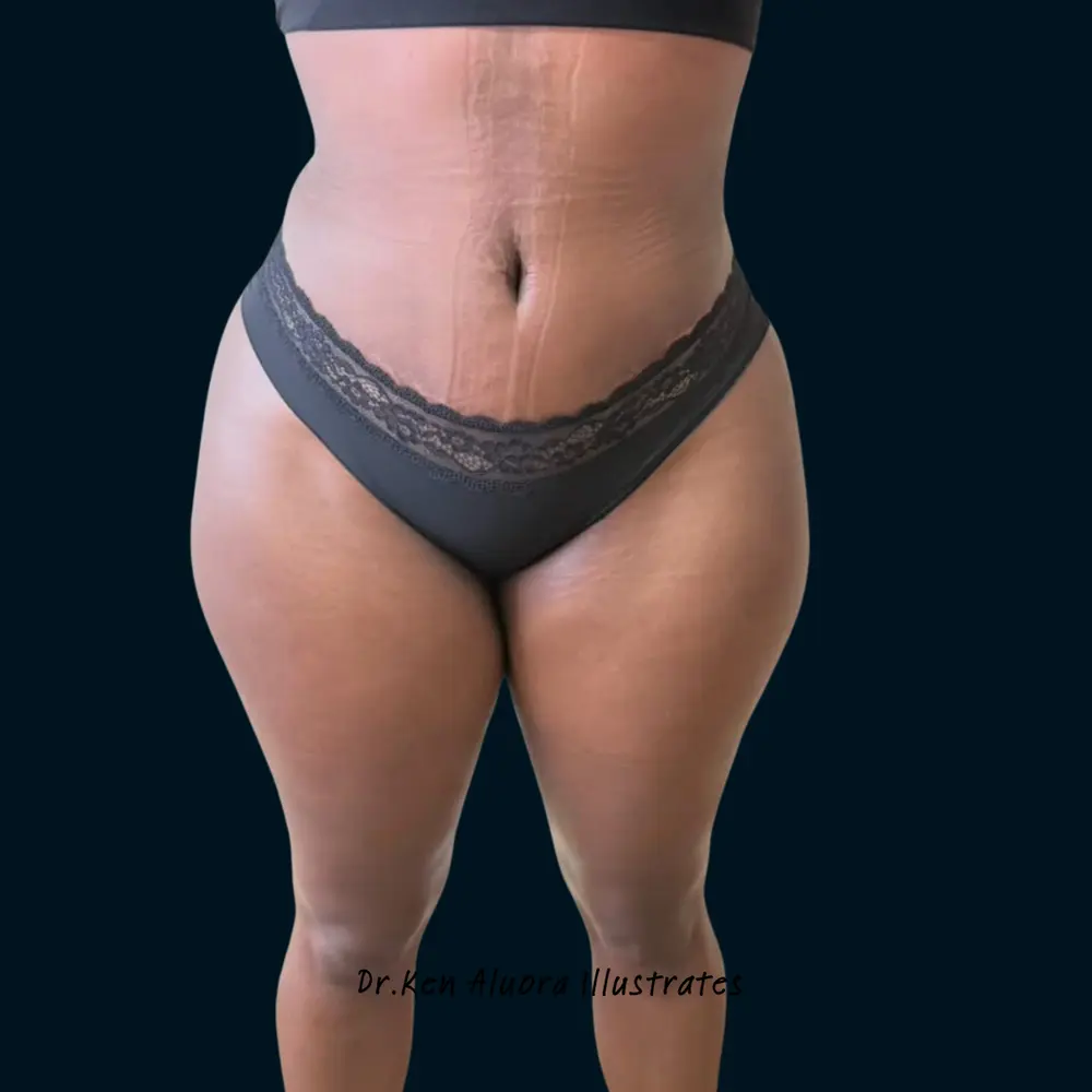 Liposuction | Hourglass Waist Contouring after